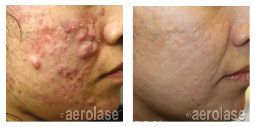 Aerolase - A 15 year old tummy tuck scar that has haunted this patient is  now almost cleared in only 4 Aerolase Neo Elite® sessions at Northeastern  Plastic Surgery office (performed by