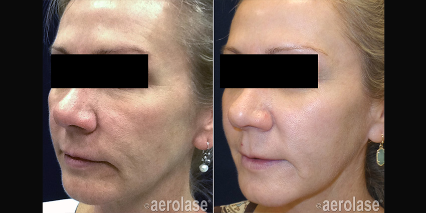 aerolase_before_and_after_1