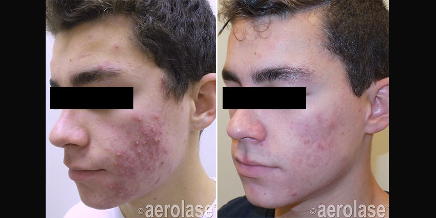 aerolase_before_and_after_2