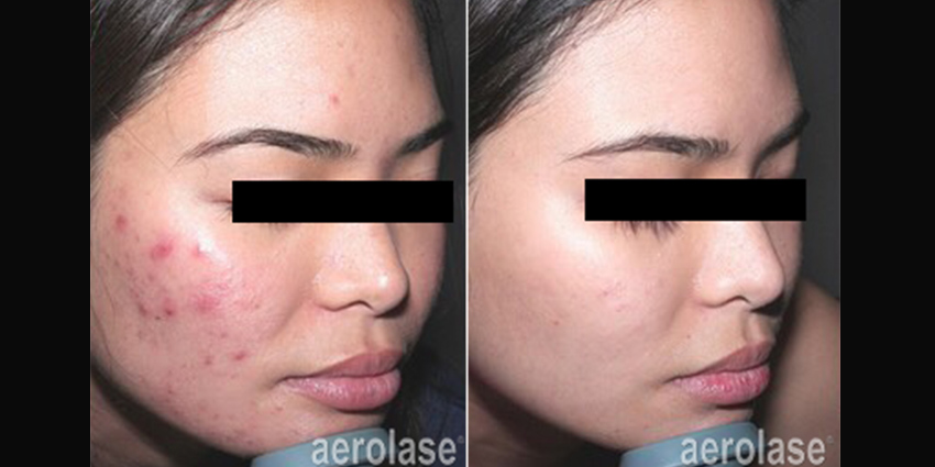 aerolase_before_and_after_3