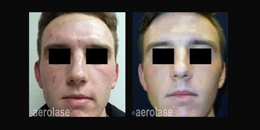 aerolase_before_and_after_4