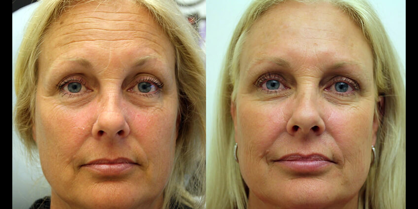 before_after_botox3