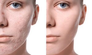 Acne scar treatments